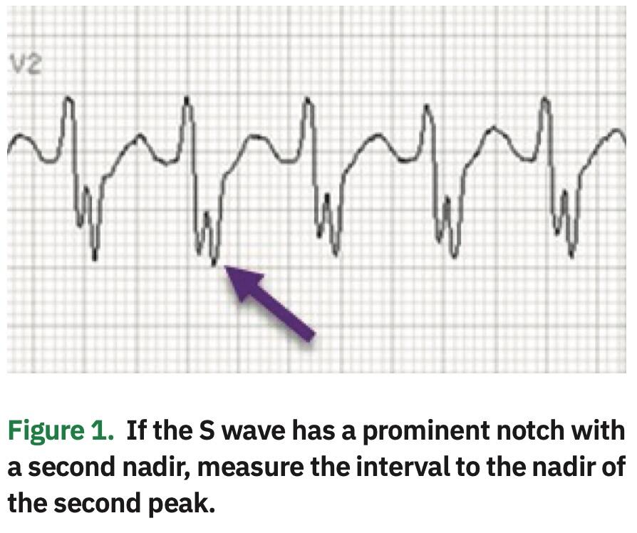 Wide Complex Tachycardias: Making the Brugada Criteria More User Friendly